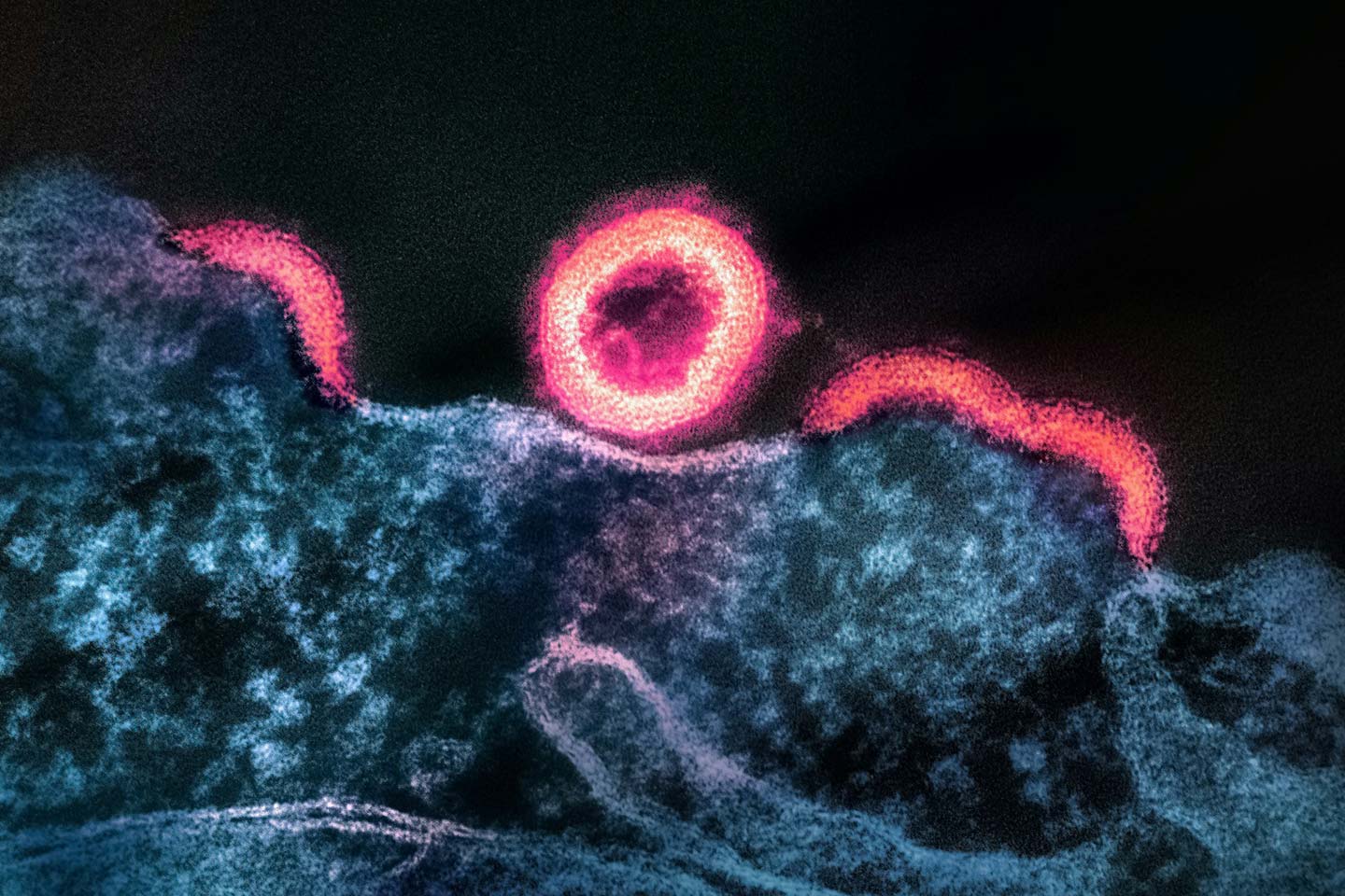 HIV